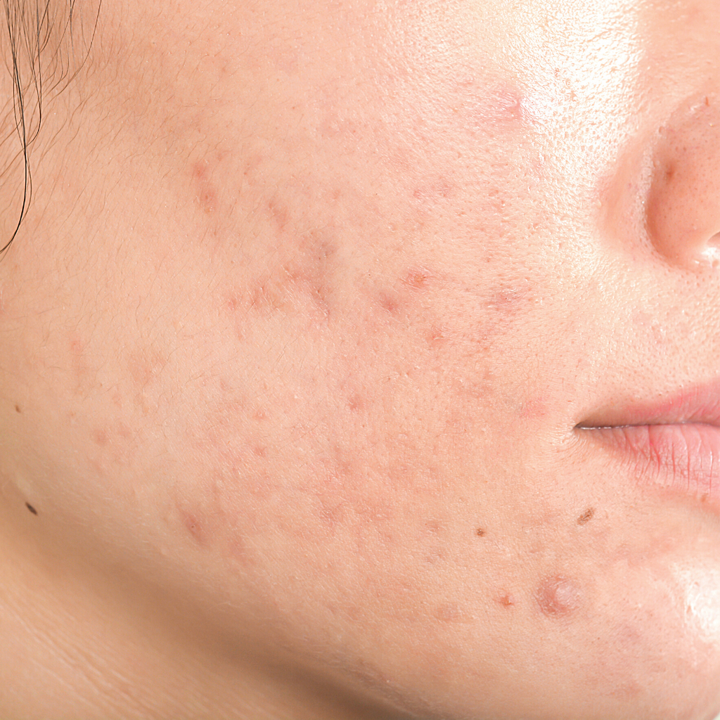 What's the Deal With Pregnancy Acne?